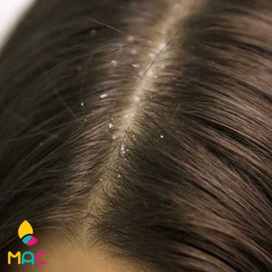 574 علت نازک شدن مو و موثرترین درمان های خانگی